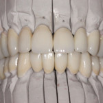 Ästhetische Zahnmedizin: Realisierung – Restauration aus feinsten lichtdurchlässigen und farblich angepassten Materialien